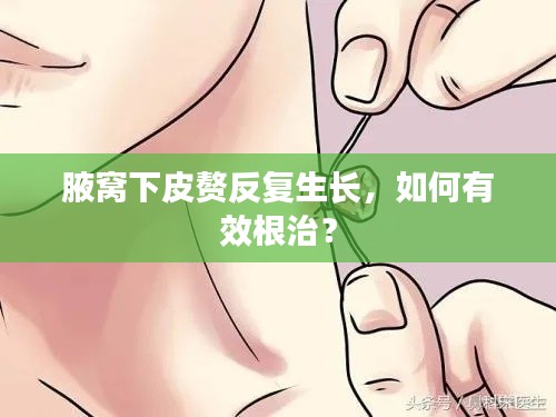 腋窝下皮赘反复生长，如何有效根治？